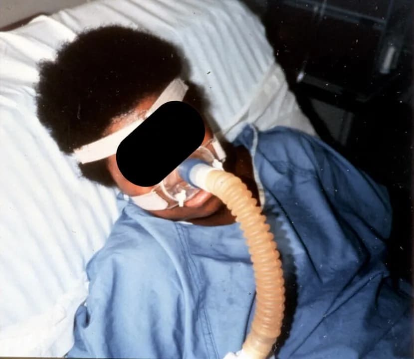 Patient with multiple sclerosis and 100 ml of VC, the first to use nasal NVS with no ventilator-free breathing ability in February 1986.
