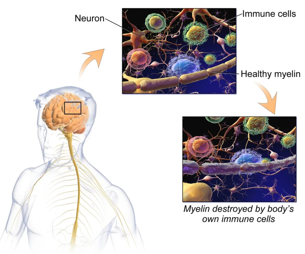 Multiple Sclerosis. This is an edited version of the source image used in the "Anatomist" app and shared here under the terms of the source image's Share Alike