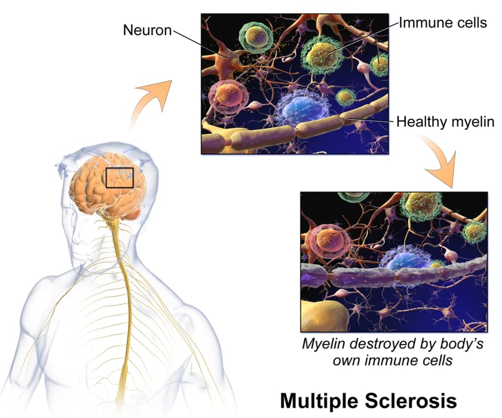 Multiple Sclerosis. See a full animation of this medical topic.
